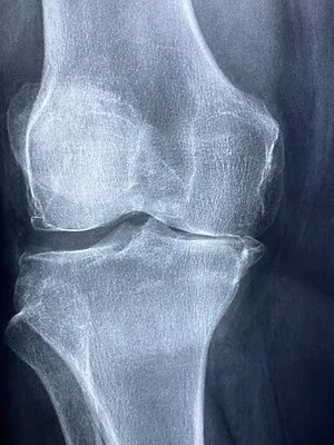 Knee Osteoarthritis: Is ‘Bone on Bone’ a painful life sentence?
