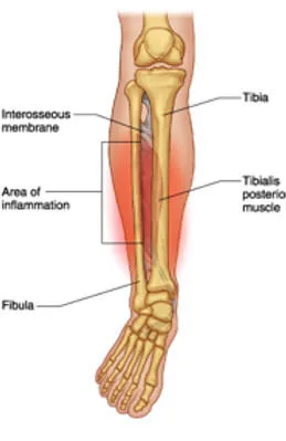 546d8b_32dd8b0ef46b498caf62a04d8b5e84ee~mv2 Mid Potion Achilles Tendinopathy Location