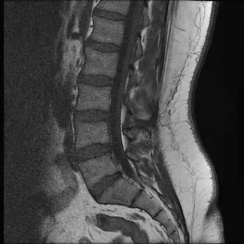 Fact or Fiction Friday – Lower back Pain and MRI’s
