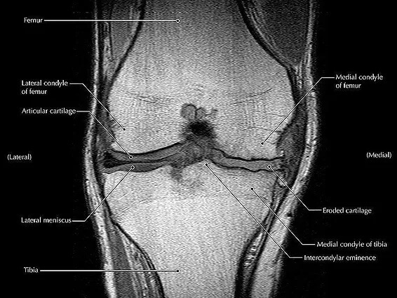 FACT OR FICTION FRIDAY || Knee Pain and Scans