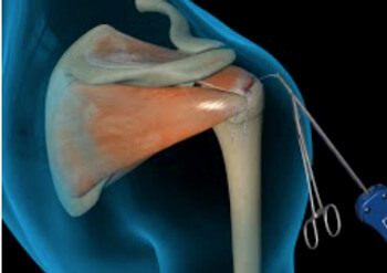 FACT OR FICTION FRIDAY || All rotator cuffs tears need surgery.