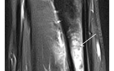 Strong Bones, Strong Runner: Understanding and Treating Stress Fractures