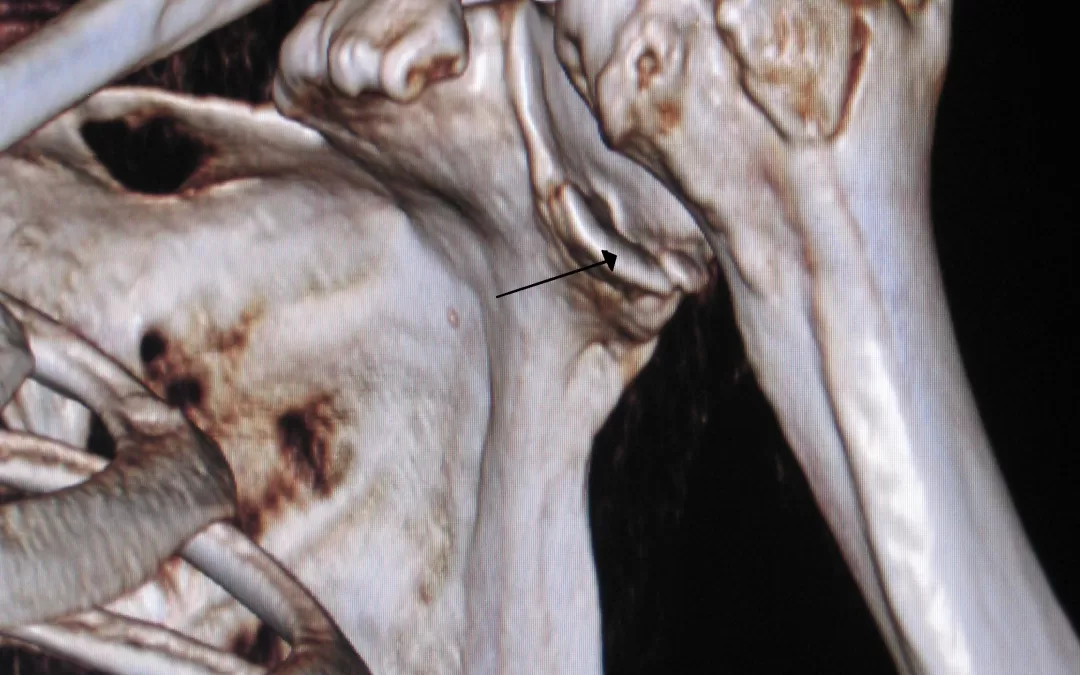 Shoulder Stabilisation and Bankart Repair: Your Path Back to Sport