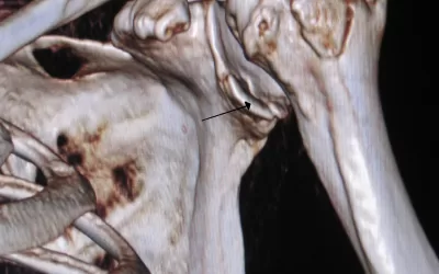 Shoulder Stabilisation and Bankart Repair: Your Path Back to Sport
