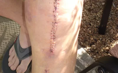 Your Guide to Total Knee Replacement Surgery