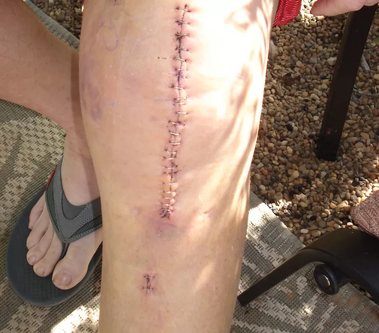 Your Guide to Total Knee Replacement Surgery