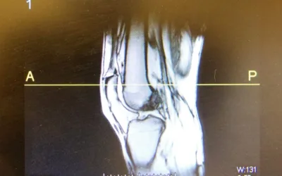 FACT OR FICTION FRIDAY || Knee Pain and Scans