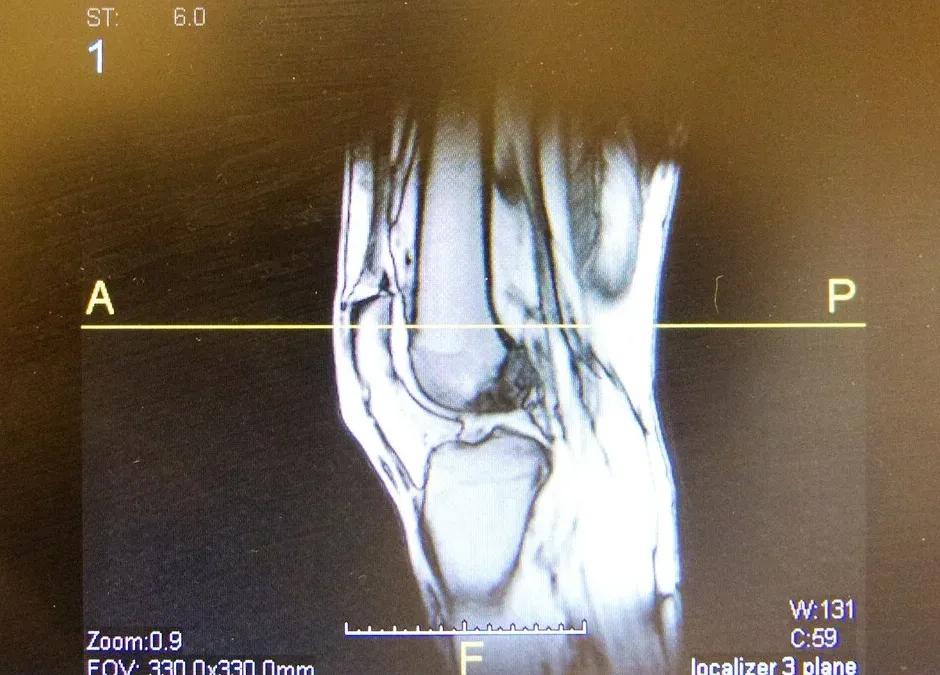 FACT OR FICTION FRIDAY || Knee Pain and Scans