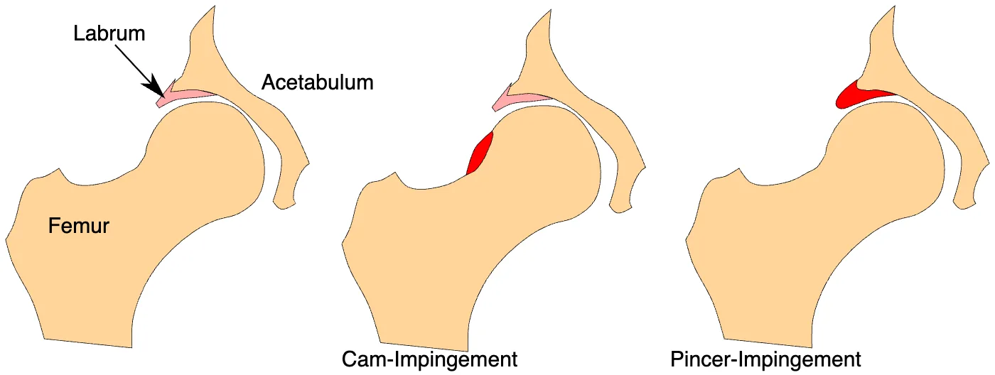 Diagram comparing normal hip anatomy with cam-type and pincer-type femoroacetabular impingement